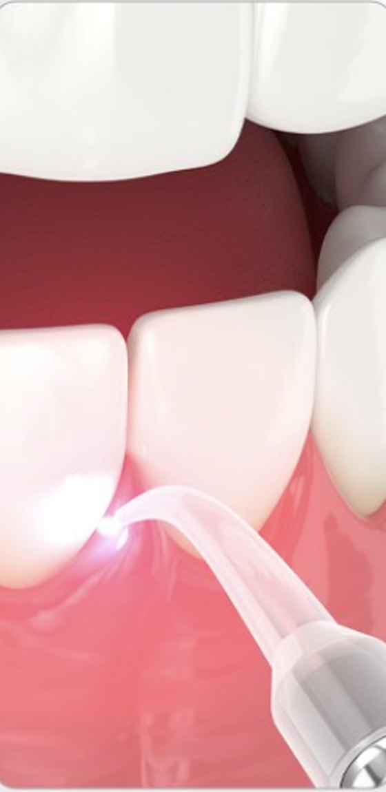 Aplicação de laserterapia na gengiva — Clínica Gnathion
