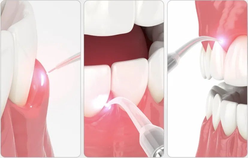 Aplicação de laserterapia em diferentes casos — Clínica Gnathion